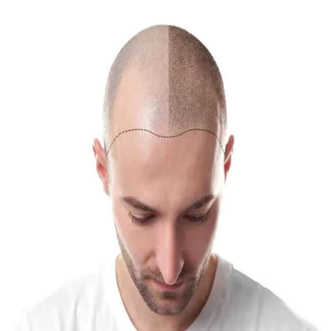 Hair Loss Male